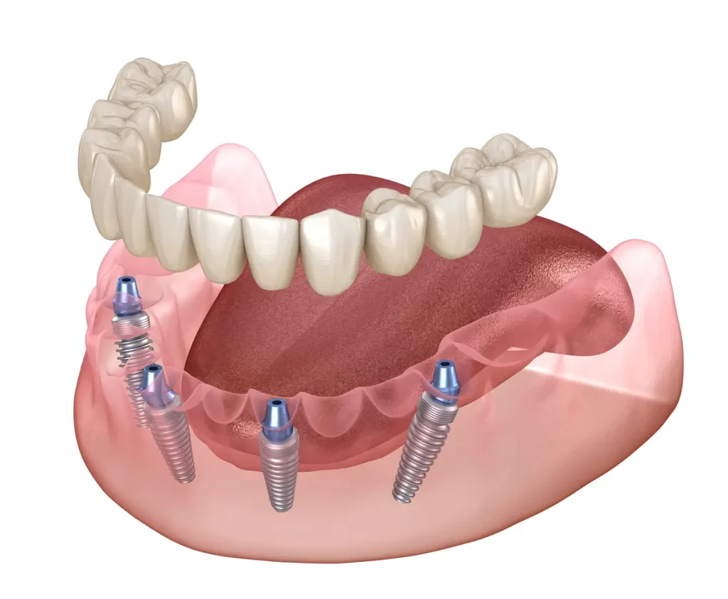all 4 dental implants